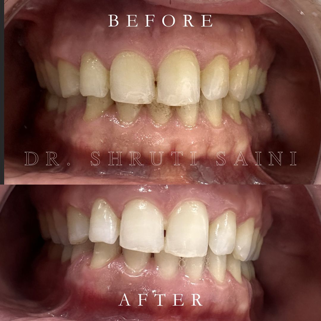Before & After
