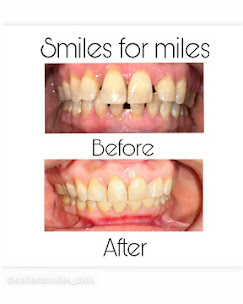 Before & After